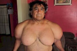 Tubuhnya Menggelembung Selama 4 Tahun, Pria Ini Baru Tahu Penyebabnya