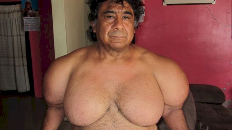 Tubuhnya Menggelembung Selama 4 Tahun, Pria Ini Baru Tahu Penyebabnya