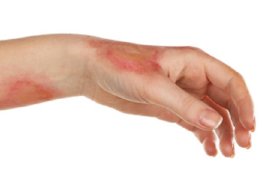 Luka Bakar Jangan Dioles Pasta Gigi, Apalagi Minyak Goreng