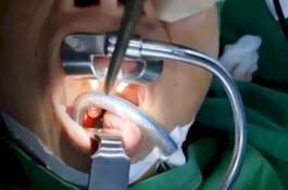 Dokter Kira Tumor, Pas Operasi Tenggorokan Malah Dapat Lintah