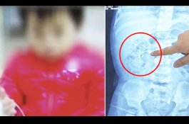 Balita Gagal Ginjal Setelah Diberi Minyak Ikan