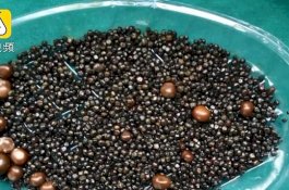 Suka Makan Makanan Berlemak, 2.000 Batu Empedu Dikeluarkan dari Wanita ini