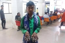 Sudah Dioperasi 25 Kali, 'Manusia Pohon' Kembali Mengeluarkan Kulit Kayu