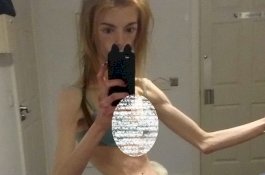 Transformasi Luar Biasa Gadis Anoreksia, Dari yang Awalnya 