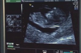 Akibatnya Bisa Fatal, Bidan Enggan Bocorkan Jenis Kelamin saat USG Ibu Hamil