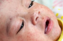 Filipina Deklarasikan Wabah Campak Setelah Ribuan Orang Tertular