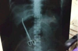 Sakit Perut Usai Operasi, Ternyata Ada Gunting Tertinggal Selama 3 Bulan