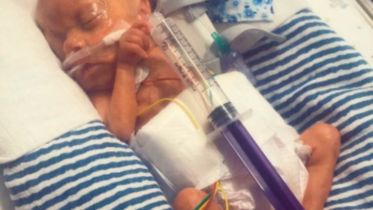 Lahir Prematur Seukuran Suntikan, Bayi Ini Secara Ajaib Bertahan Hidup