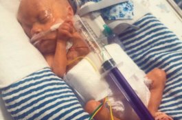 Lahir Prematur Seukuran Suntikan, Bayi Ini Secara Ajaib Bertahan Hidup