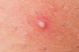 Awas! Bisul Bisa Berbahaya Bagi Pengidap Diabetes