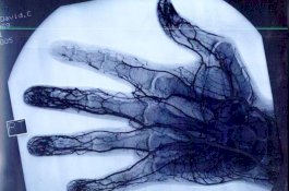 Ngeri! Begini Penampakan Jari Tangan Pemain Yoyo Profesional