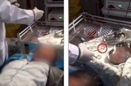 Ngeri! Dokter Keluarkan Lintah Hidup 6cm dari Hidung Pasien