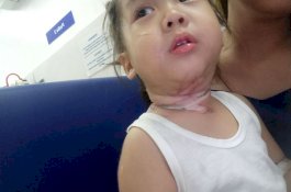 Balita Menderita Luka Bakar Akibar Kabel Meledak dan Melilit Lehernya