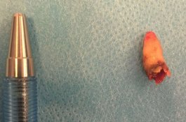 2 Tahun Sulit Bernafas, Ternyata Gigi Pria Ini Tumbuh di Dalam Hidung