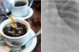 Minum 10 Gelas Kopi Sehari, Tulang Wanita Ini Rapuh Seperti Tulang Nenek-nenek