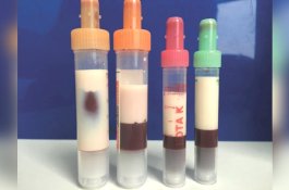 Darah Pria Ini Mengental dan Putih, Dokter Obati Pakai Teknik Kuno