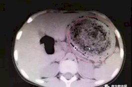 Bola Rambut Seberat 1,5 Kg Ditemukan di Perut Bocah 8 Tahun Ini