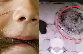 Kunyah Rambut Selama 6 Tahun, Dokter Temukan Bendah Aneh di Perut Gadis Ini