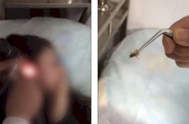 Ngeri! Kecoak Hidup Ditarik Dari Telinga Gadis 17 Tahun