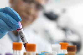 Pasien Sembuh Dari Virus HIV Setelah Transplantasi Sumsum Tulang