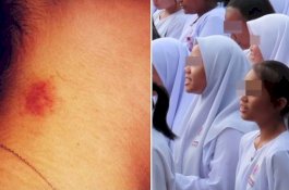 Ibu Kaget Lihat Cupang di Leher Putrinya, Ternyata Dia Mengaku Sudah Ditiduri 5 Pria