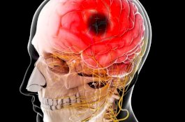 Wanita Ini Stroke Saat Hampir Orgasme Selama Berhubungan Intim