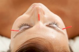 Apakah Akupunktur Dapat Membantu Menurunkan Berat Badan?