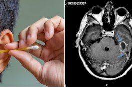 Gara-gara Sering Gunakan Cotton Bud, Pria Ini Derita Infeksi Otak