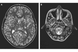 Cacing Pita Bertelur di Otak Remaja Asal India Ini