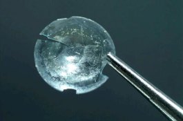 Wanita Ini Baru Sadar Lensa Kontaknya Tertanam 30 Tahun di Kelopak Mata