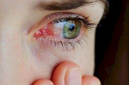 Mata Merah: Gejala dan Cara Mengobatinya