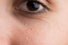 Cara Menyingkirkan Milia, Kista Kecil di Wajah