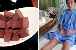 Makan Darah Babi, Pria Ini Diserang Infeksi Mematikan, Kakinya Terpaksa Diamputasi