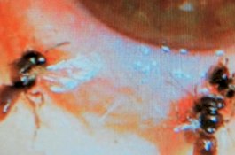 Video: 4 Ekor Lebah Hidup Ditemukan di Mata Perempuan asal Taiwan