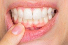 Tak Sikat Gigi Usai Minum Susu, 18 Gigi Bocah 4 Tahun Rusak Parah