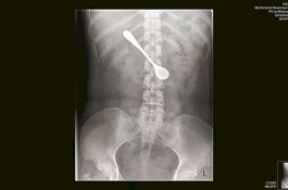 Wanita ini Telan Sendok Saat Mencoba Hilangkan Tulang Ikan di Tenggorokannya