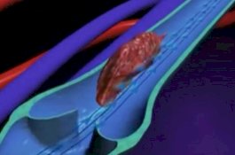 Ini 9 Sinyal yang Dikeluarkan Tubuh Ketika Anda Memiliki Bekuan Darah