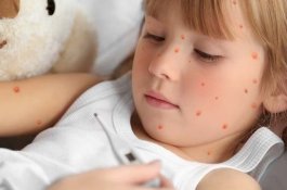 Perawatan Efektif Untuk Mengobati Cacar Air