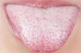 Lidah Anda Putih? Ini Gambaran tentang Kesehatan Anda