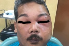 Obati Sakit Gigi dengan Minyak Rem, Pipi Pria Ini Berlubang