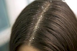 Jenis-jenis Ketombe yang Harus Anda Tahu