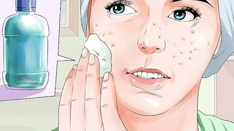Ilustrasi jerawat