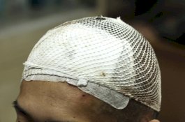 Dokter Masukkan 'Saklar' ke Otak Pasien untuk Obati Kecanduannya Pada Opioid