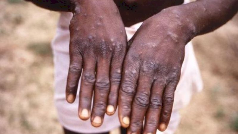 FOTO: CDC / BRIAN WJ MAHY