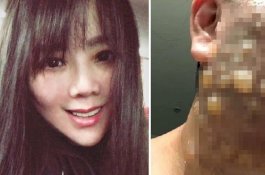 Operasi Plastik, Wajah Wanita Cantik Ini Terbakar