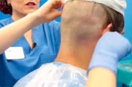 Mau Mirip Wayne Rooney, Pria Ini Meregang Nyawa Saat Transplantasi Rambut