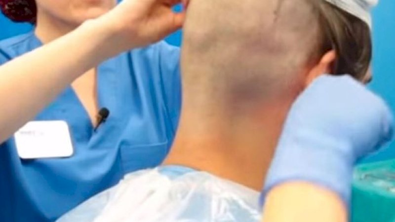 Mau Mirip Wayne Rooney, Pria Ini Meregang Nyawa Saat Transplantasi Rambut