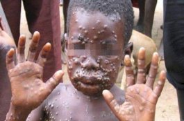 Ciri-Ciri Cacar Monyet yang Tengah Diwaspadai Masuk Indonesia