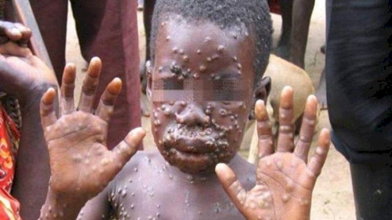 Kondisi bocah Afrika yang badannya terserang virus cacar monyet atau monkeypox. 