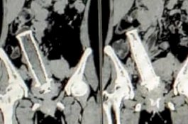 Mabuk, Suami Masukkan Pegangan Motor ke Rahim Istrinya